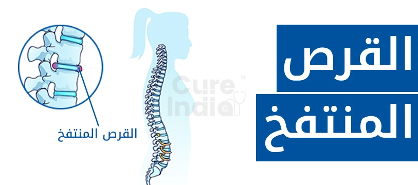 انتفاخ القرص